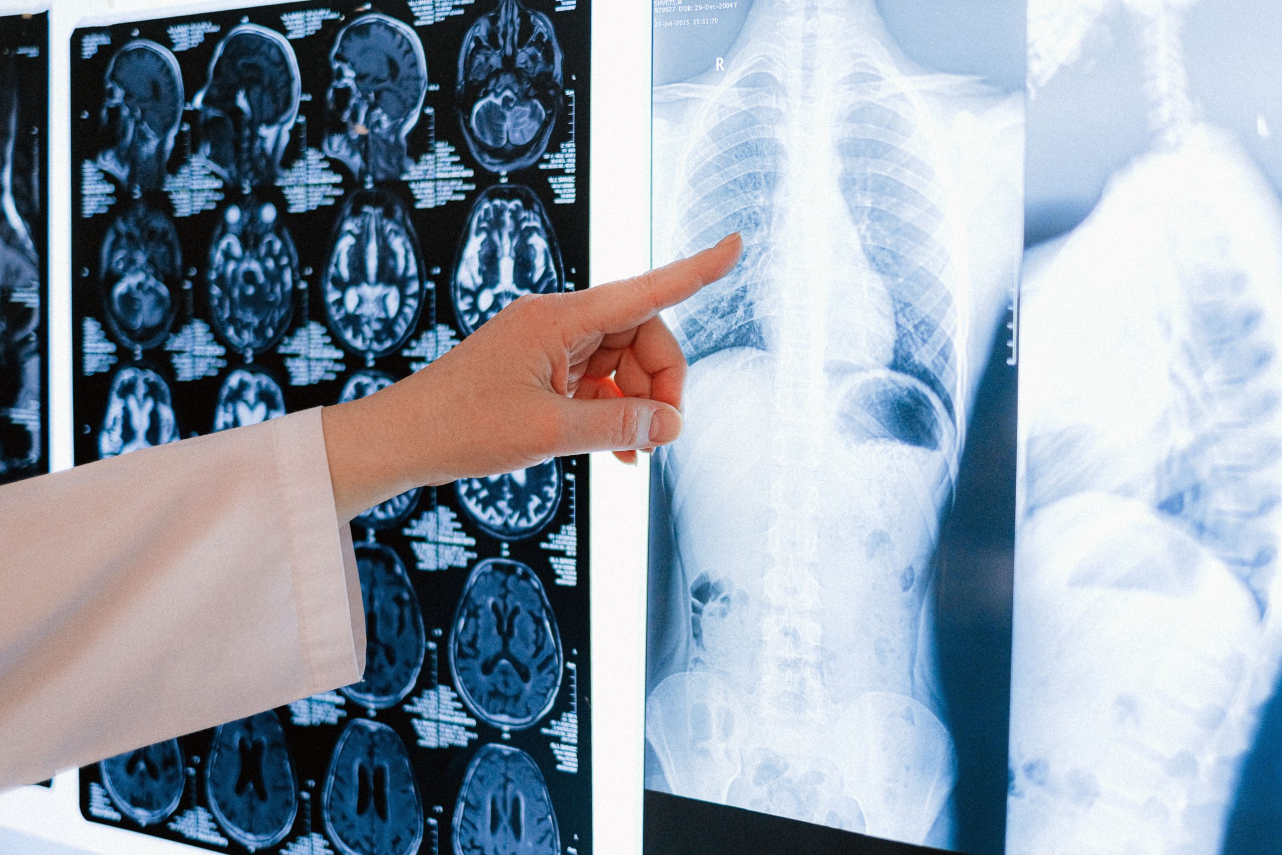 Médecin pointe une radio thoracique parmi des IRM