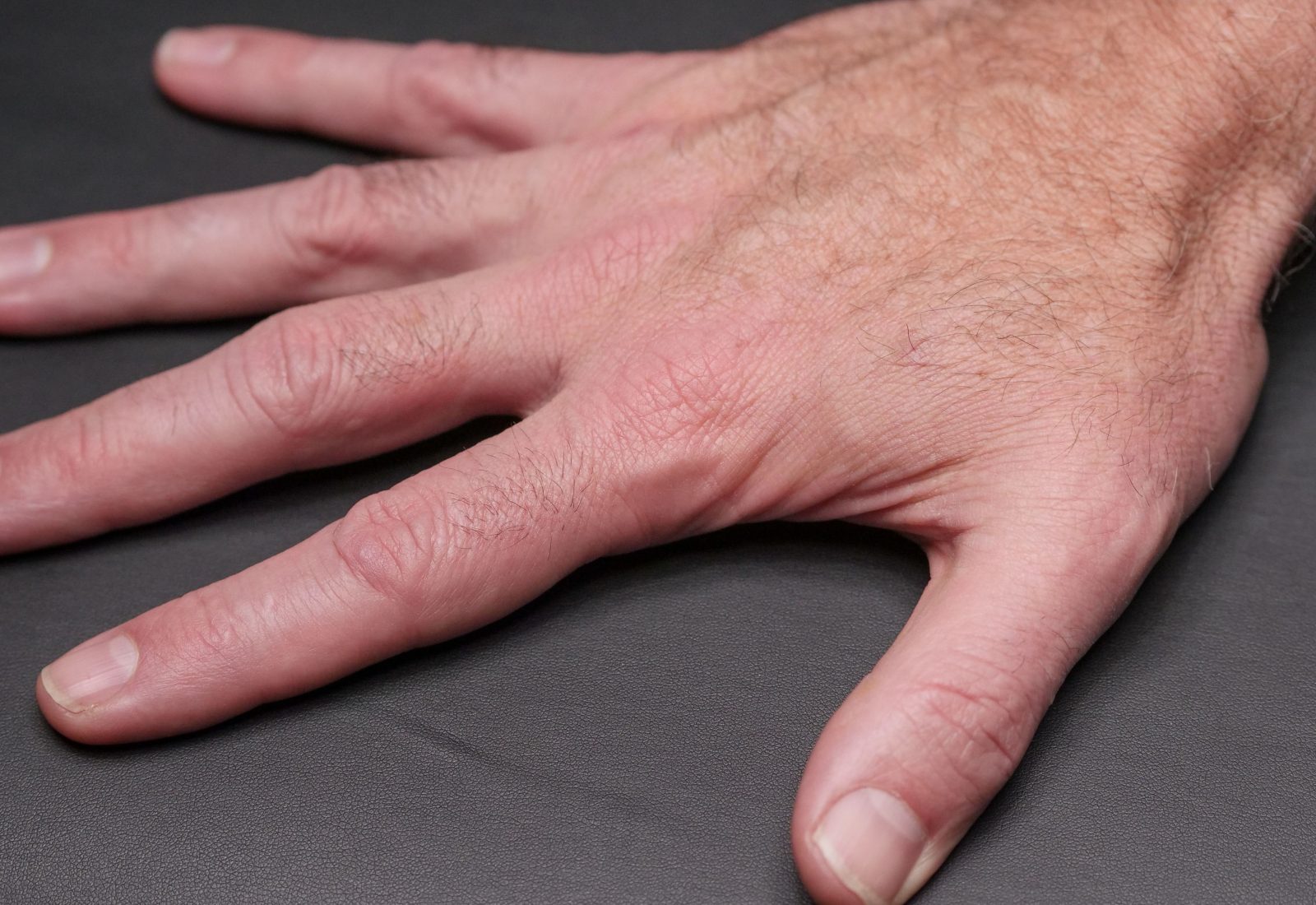 Ongle de Terry : quelle maladie se cache derrière ce symptôme ?